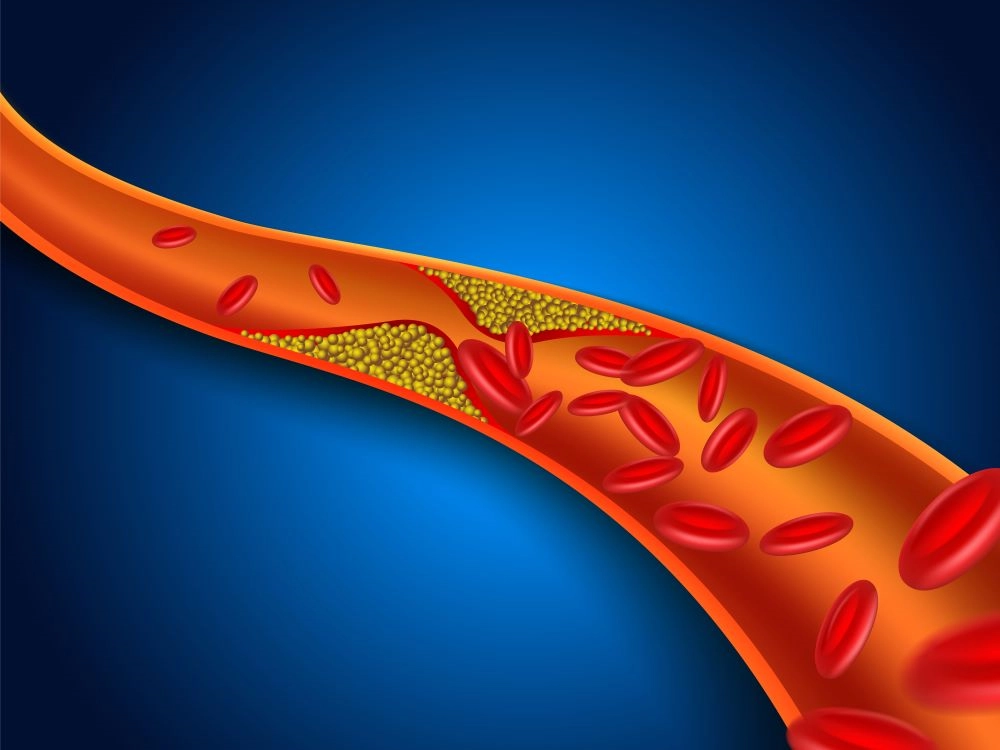 Cholesterol treatment